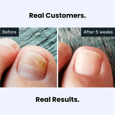 Antifungal Pen